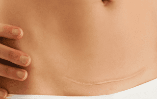 betaterapia previne queloides