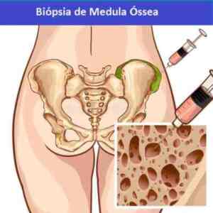 Biopsia-de-Medula-Ossea